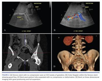 (A) Venovo stent with no compression seen at 33.5 weeks of gestation. (B.) Color Doppler within the Venovo stent showing good flow. (C) Stent post partum fully expanded with no compression or deformation. (D) Stent on three-dimensional imaging with good positioning and full expansion.