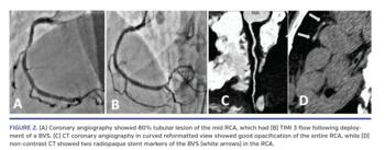 (A) Coronary angiography showed 80% tubular lesion of the mid RCA, which had (B) TIMI 3 flow following deployment of a BVS. (C) CT coronary angiography in curved reformatted view showed good opacification of the entire RCA, while (D) non-contrast CT showed two radiopaque stent markers of the BVS (white arrows) in the RCA.