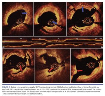 Optical coherence tomography (OCT) across the proximal RCA following rotablation