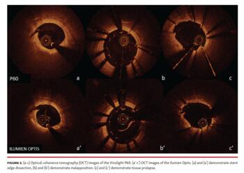 Figure 3. Optical coherence tomography