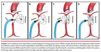 Figure 3. Gore Cardioform atrial septal defect occluder deployment using assistance