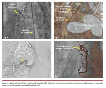 Visualization of culprit collaterals
