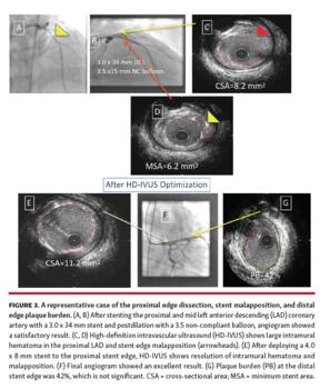 A representative case of the proximal edge dissection, stent malapposition, and distal edge plaque burden.