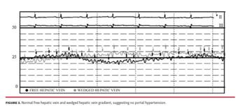 Normal free hepatic vein and wedged hepatic vein gradient, suggesting no portal hypertension.