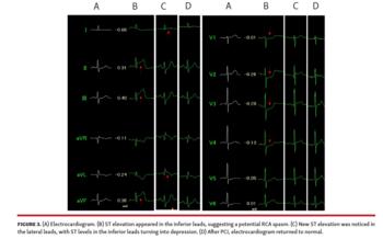 Electrocardiogram
