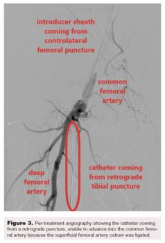Fig 3. Per-treatment angiography