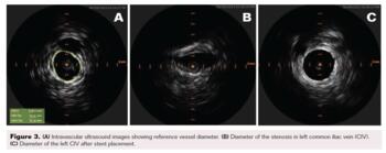 Fig 3. Vessel diameter before and after stent placement 
