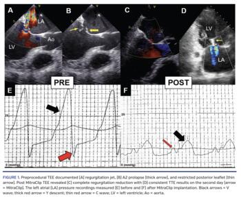 Preprocedural TEE documented (A) regurgitation jet, (B) A2 prolapse (thick arrow), and restricted posterior leaflet (thin arrow). Post MitraClip TEE revealed (C) complete regurgitation reduction with (D) consistent TTE results on the second day (arrow = MitraClip). The left atrial (LA) pressure recordings measured (E) before and (F) after MitraClip implantation. Black arrows = V wave; thick red arrow = Y descent; thin red arrow = C wave; LV = left ventricle; Ao = aorta.