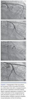 Angiography of the procedure. (A) Occlusion of the circumflex (CX) artery on a bifurcation site with a marginal branch. (B) Coronary aspiration removed embolic debris; repeated aspirations resulted in TIMI 2 flow restoration in the marginal branch with persistent occlusion of the CX. (C, D) Kissing-balloon inflation restored complete revascularization of the CX territory.