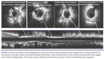 IVUS run showed stent malapposition across the entire stented segment with insignificant in-stent restenosis in the ostial to mid LAD. A gross mismatch between MLD (mean cross-sectional area of the stent) versus the MVD was suggestive of stent malapposition. The values of each of these parameters are shown in the corresponding LAD segments.