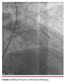 Delivery of 4 cycles of Shockwave lithotripsy.