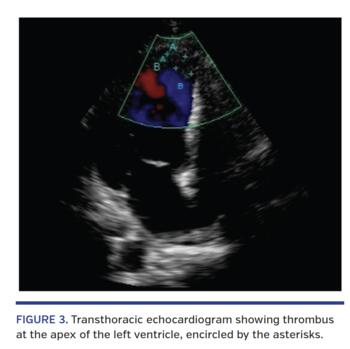 Transthoracic echocardiogram showing thrombus at the apex of the left ventricle, encircled by the asterisks.