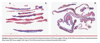 Figure 4. Representative images of tissue removed by the atherectomy device.