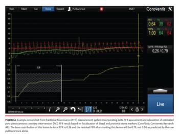 Example screenshot from fractional flow reserve (FFR) measurement system incorporating delta FFR assessment and calculation of estimated post-percutaneous coronary intervention (PCI) FFR result