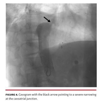 Cavogram with the black arrow pointing to a severe narrowing at the cavoatrial junction.
