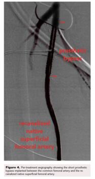 Fig 4. Short prosthetic bypass implanted 