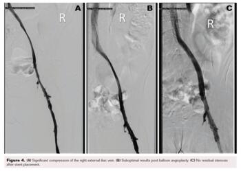Stenosis before and after stent placement 