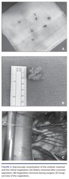Macroscopic examination of the embolic material and the mitral vegetation. (A) Debris removed after coronary aspiration. (B) Vegetation removed during surgery. (C) Surgical view of the vegetation.