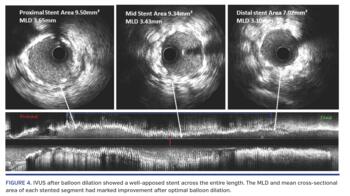 IVUS after balloon dilation showed a well-apposed stent across the entire length. The MLD and mean cross-sectional area of each stented segment had marked improvement after optimal balloon dilation.