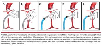 Figure 5. Gore Cardioform atrial septal defect occluder deployment using assistance