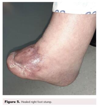 Fig 4. Healed right foot stump