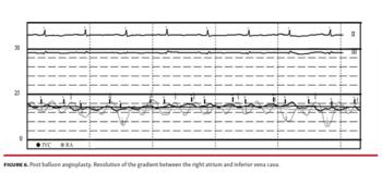 Post balloon angioplasty. Resolution of the gradient between the right atrium and inferior vena cava.