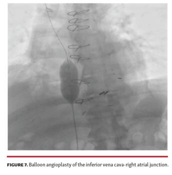 Balloon angioplasty of the inferior vena cava-right atrial junction