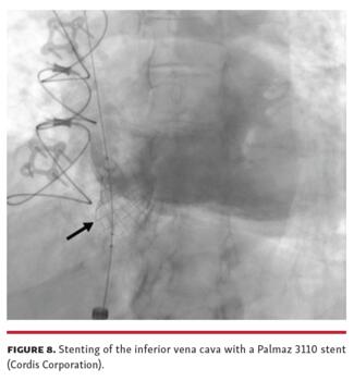 Stenting of the inferior vena cava with a Palmaz 3110 stent (Cordis Corporation).