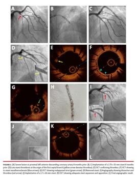 Severe lesion at proximal left anterior descending coronary artery 8 months prior