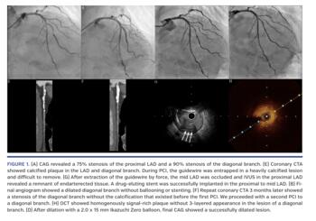 CAG revealed a 75% stenosis of the proximal LAD and a 90% stenosis of the diagonal branch