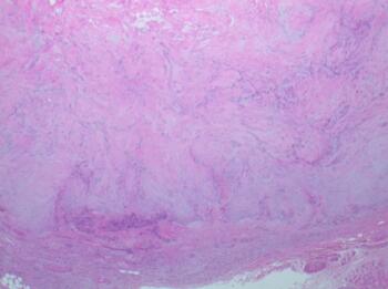 Above reflects an H & E stain of the mass in question.