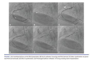 Calcified lesions at the RCA (asterisks). (B) ELCA catheter crossing mid RCA (arrow