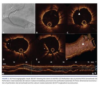Final angiographic result. (B) OCT showing the stent at mid RCA.