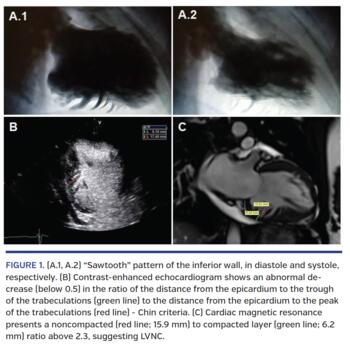 Left Ventricular Noncompaction: