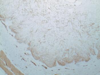 This image is a muscle-specific actin stain of the mass in question.