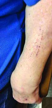 The patient also presented with excoriations on the forearm, as seen in this photo.