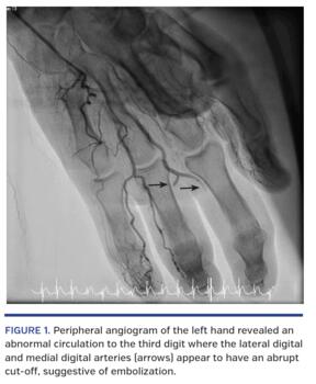Peripheral angiogram of the left hand