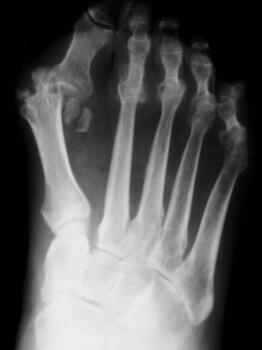 A 2019 study also found that metformin may protect bones during the early stages of disease, decrease inflammation, and modify risk for cardiovascular disease and cancer in patients with rheumatoid arthritis, such as in the case depicted above. Photo courtesy of Guy Pupp, DPM and colleagues.