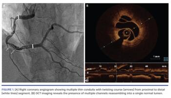 Right coronary angiogram