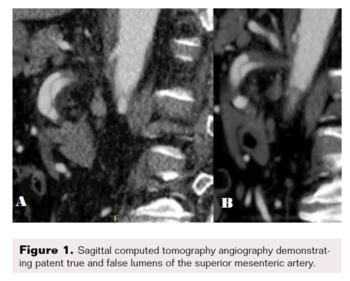 Sagittal CT showing patent true and false lumens. 