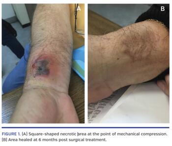 Square-shaped necrotic area