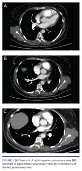 Stenosis of right superior pulmonary vein