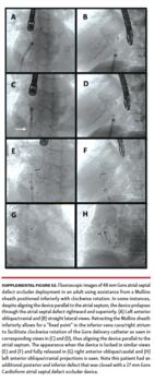 Fluoroscopic images of 48 mm Gore atrial septal defect occluder deployment
