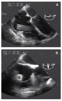 Transesophageal echocardiography
