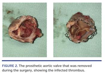 prosthetic aortic valve