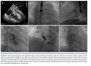 (A) Echocardiogram with agitated saline demonstrating moderate right-to-left shunt from the inferior aspect of the ASD occluder device. Glidewire passing around the waist of the ASD occluder device in (B) anteroposterior and (C) lateral views. Doughnut-shaped leak along the waist of the ASD occluder device connecting right and left atrium demonstrated via angiography in (D) anteroposterior and (E) lateral view