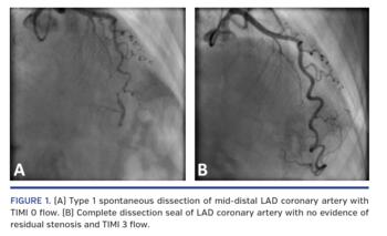 (A) Type 1 spontaneous dissection of mid-distal LAD coronary artery with TIMI 0 flow. (B) Complete dissection seal of LAD coronary artery with no evidence of residual stenosis and TIMI 3 flow.