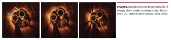Optical coherence tomography (OCT) images of distal right coronary artery. Blue arrow = OCT catheter; green arrows = crop circles.