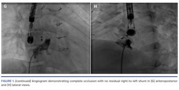 (continued) Angiogram demonstrating complete occlusion with no residual right-to-left shunt in (G) anteroposterior and (H) lateral views.